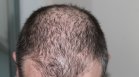 Лекар: Голям процент от преболедувалите Ковид-19 страдат от косопад месеци наред